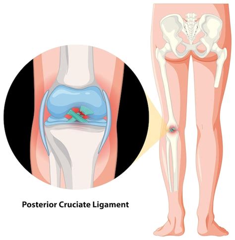 Anatomia do ligamento cruzado posterior Vetor Grátis