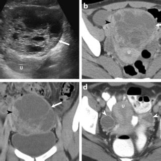 A 48 Year Old Female Presented With Abdominal Discomfort And Swelling