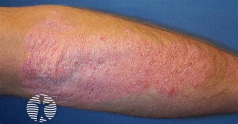 DermNet Large Plaque Psoriasis Image