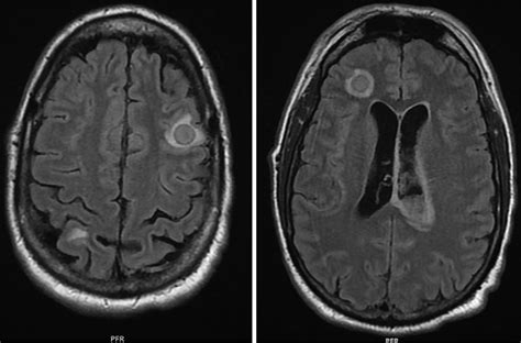 Brain Mri Showing Multiple Abscesses In The Frontal Lobe Right Download Scientific Diagram