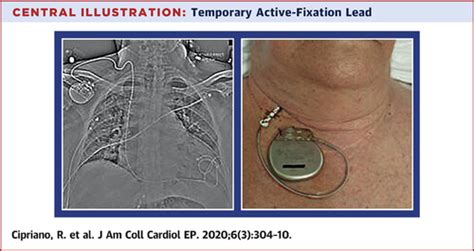 Outcomes Of Standard Permanent Active Fixation Leads For Temporary