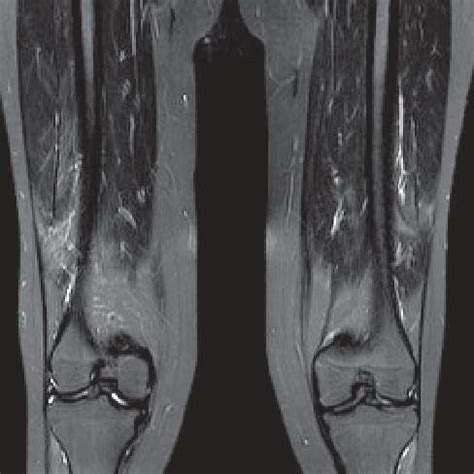 Lesion Patterns On Conventional MRI In Leukodystrophies And