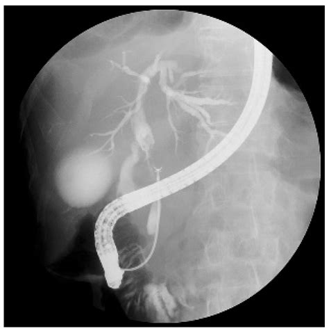 Peroral Cholangioscopy Guided Targeted Biopsy Versus Conventional