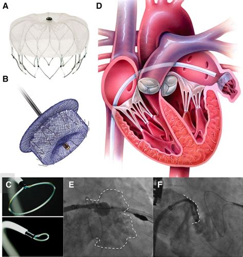 Abbott S Amplatzer Amulet To Reduce Stroke In Patients Suffering From Af