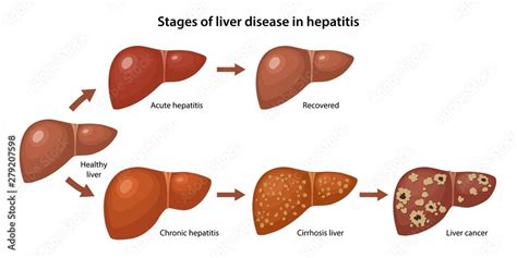 Acute Hepatitis Liver