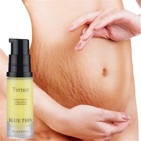 Removal Acne Scar Stretch Marks Cream Scar Striae Gravidarum Treatment