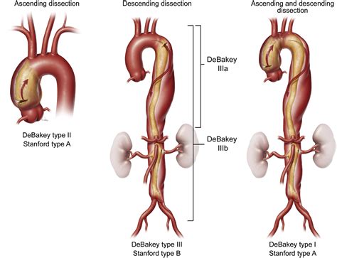 Medical Or Endovascular Management Of Acute Type B Aortic Dissection The Journal Of Thoracic