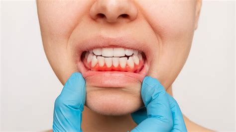 Healthy Gums Know How It Can Prevent A Number Of Diseases Onlymyhealth