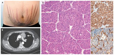 Ectopic Cushings Syndrome — Nejm