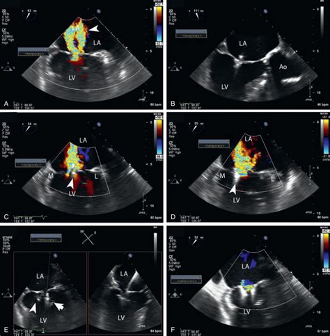 Uncomplicated Transcatheter Mitral Valve Repair With Mitraclip