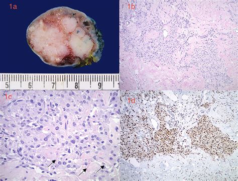 Ovarian Leydig Cell Tumor Associated With Recurrent Torsion And