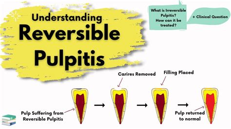 Reversible Pulpitis Causes Diagnosis And Treatment Endodontics