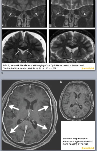 CSF spaces – Brain – bit by bit