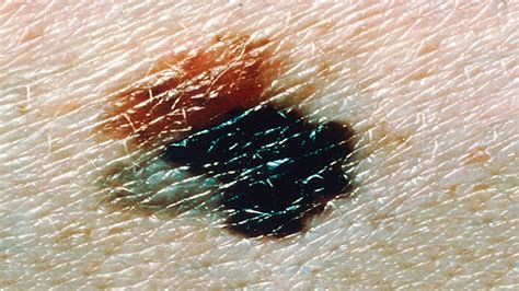 Dog Cancerous Mole