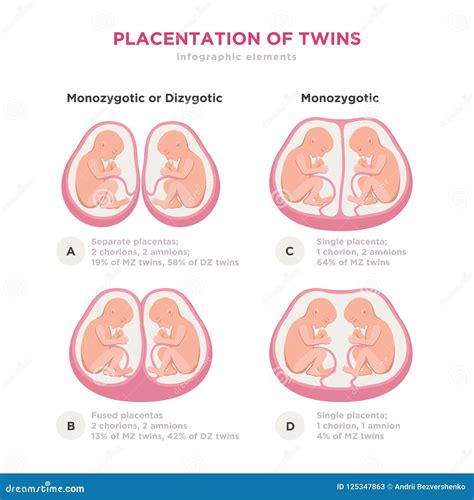 Types Of Monozygotic Twins