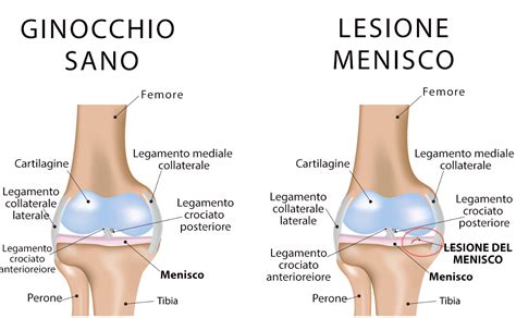 LESIONI DEL MENISCO Dott Marco Capuzzo