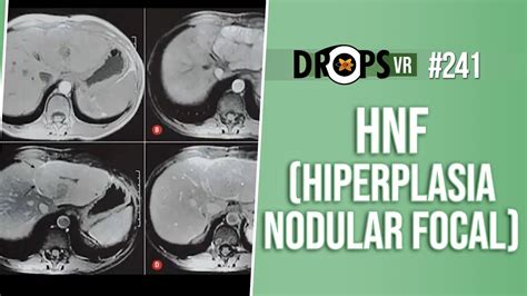 Hiperplasia Nodular Focal O Que E Como Se Manifesta Youtube