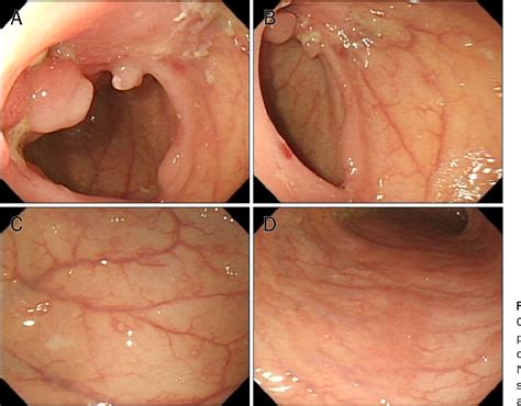 Figure From A Case Of Igg Related Sclerosing Mesenteritis