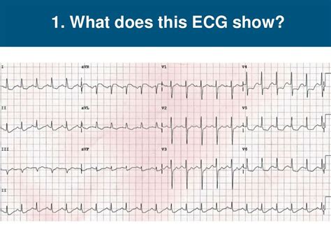 Ecg Interpretation Nstemi