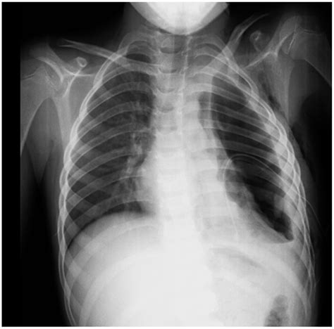 Post Operative Chest X Ray Regression Of The Hydro Pneumothorax Size A