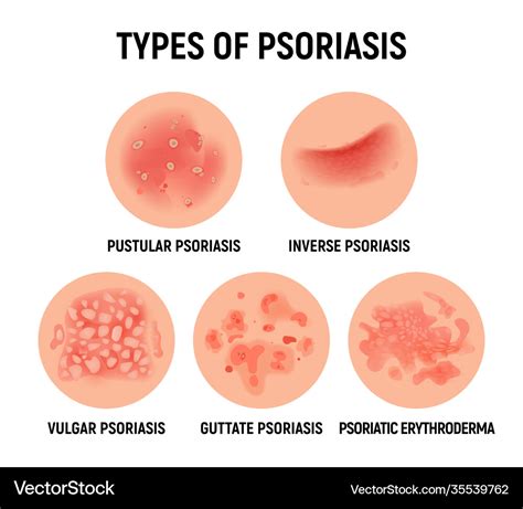 Psoriasis rash skin hand infection Royalty Free Vector Image