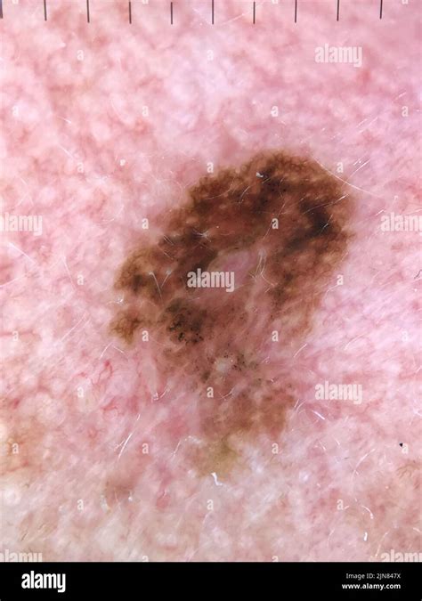 Melanoma In Situ Dermoscopy Stock Photo Alamy