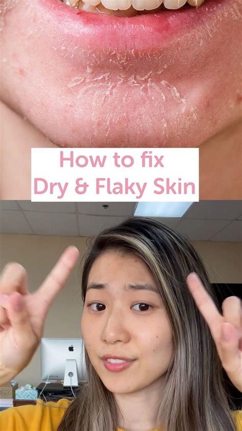 How To Get Rid Of Dry Flaky Skin On Body Artofit