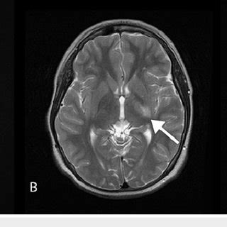 MRI In Axial Planes Showing T2 Weighted A T1 Weighted B And SWI