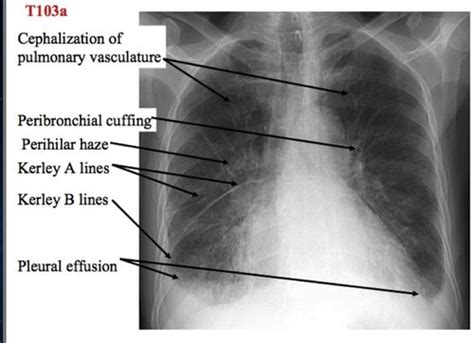 Chest X Ray Flashcards Quizlet