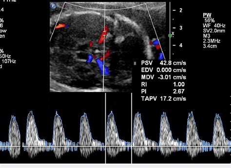 Doppler Showing Peak Systolic Velocity Of 294 160 Mom Mom Multiple Download Scientific