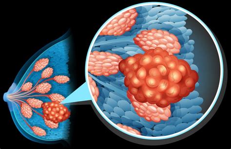 Fisiopatologia Del Cancer De Mama