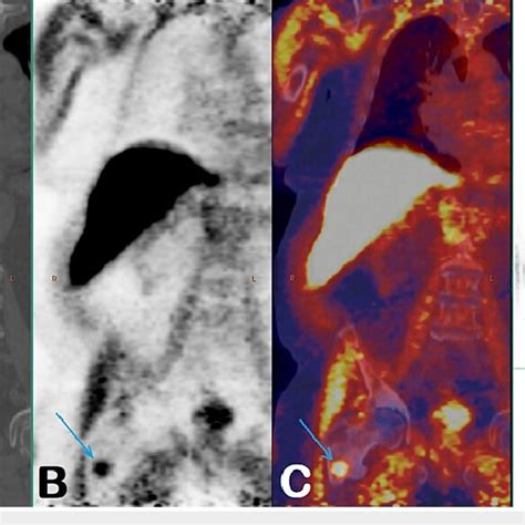 Findings On The Fluoride 18 Fluciclovine PET CT Scan In October 2021 CT