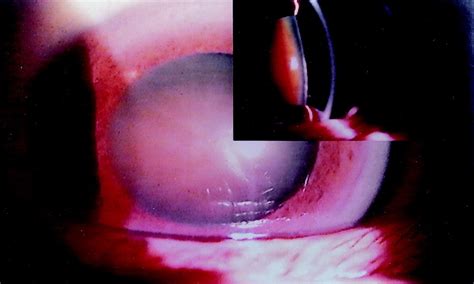 Phacoemulsification Of Brunescent And Black Cataracts Journal Of