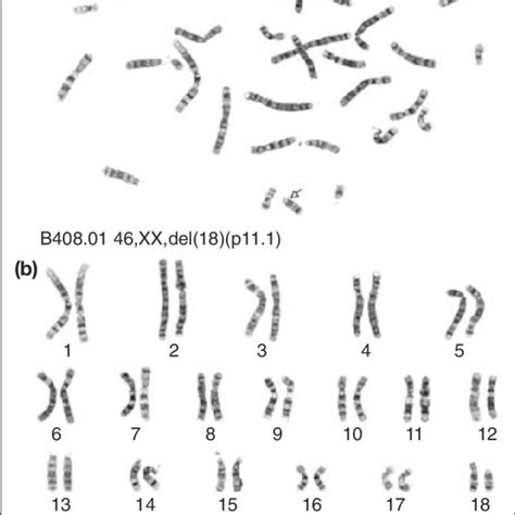 G Banded Chromosomes From A Female With An 18p Deletion And The Xx Sex Download Scientific