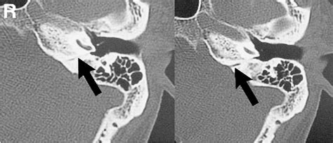 Figure 3 From Contralateral Hearing Disturbance Following Posterior Fossa Surgery —case Report