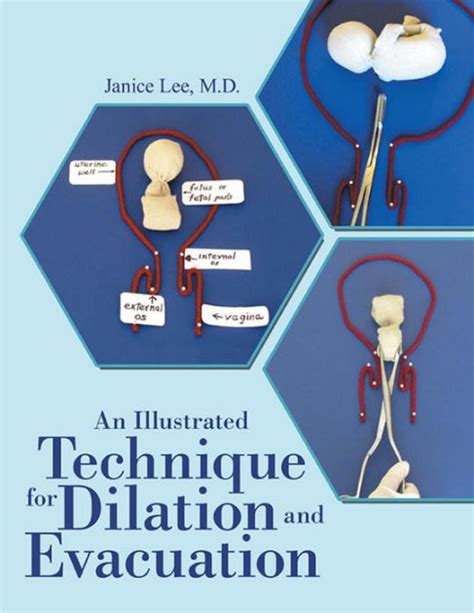 An Illustrated Technique for Dilation and Evacuation by Janice Lee M.D ...