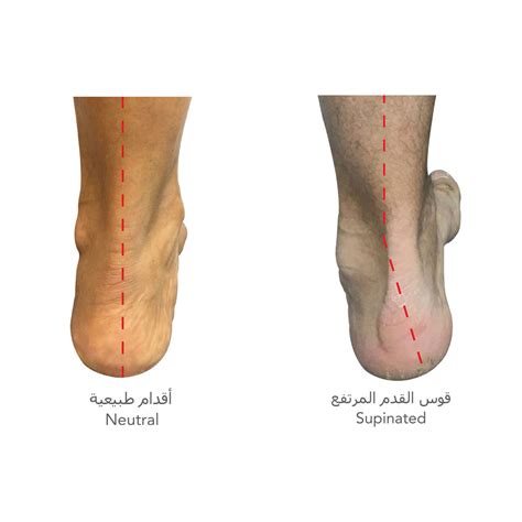 Flat Foot Center Supination And High Arch Image Dubai Podiatry Centre