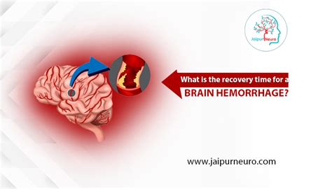 What is the Recovery time for a Brain hemorrhage? | Jaipur Neuro