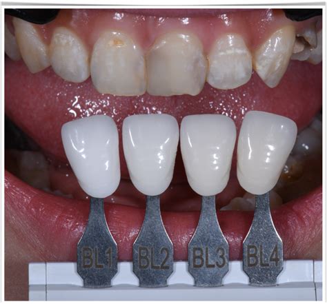 Aesthetic Porcelain Veneers Illustrated Step By Step