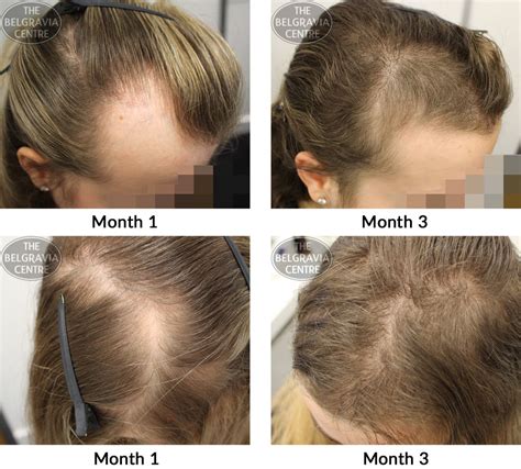 Alopecia Areata Treatment Before And After