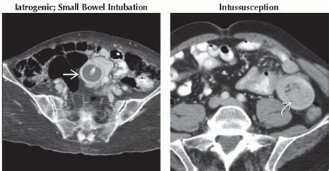 Da Db Small Bowel Obstruction Ffu Abdominal Key