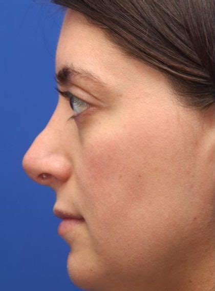 Patient 13551 Septoplasty Before And After Photos New York Ny