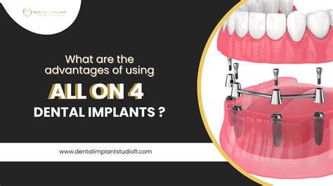 All On Dental Implants In Miami Lakes Fl