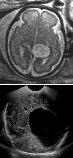 Upper Axial T Weighted Mr Image Of The Brain Obtained In A