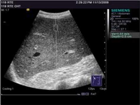 Ch 03 Liver Elastography Efsumb