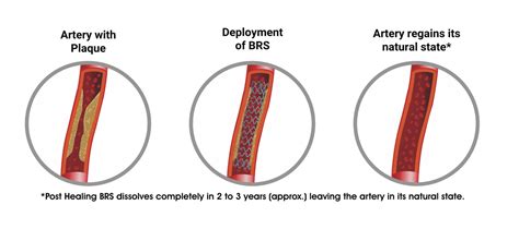 Know The Advantages Of Bioresorbable Vascular Scaffold Meril Life