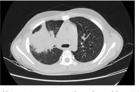 Figure From Loeffler S Syndrome Mimicking Lung Tumor And Pneumonia In