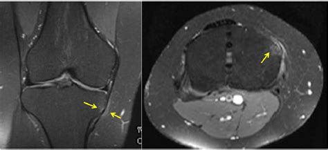 Figure 1 From Medial Tibial Condyle Friction Syndrome MRI Study Of A