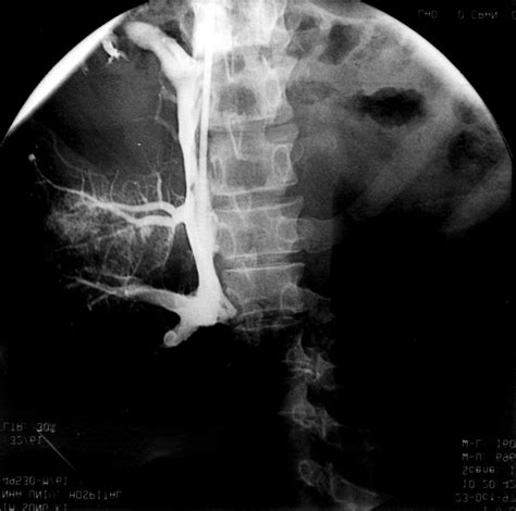 Venogram After Thrombectomy And Thrombolytic Theraphy Showing Download Scientific Diagram