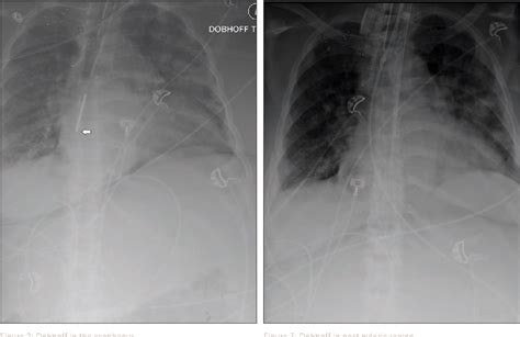 Figure 1 From Technique For Safe Placement Of A Dobhoff Tube Without A